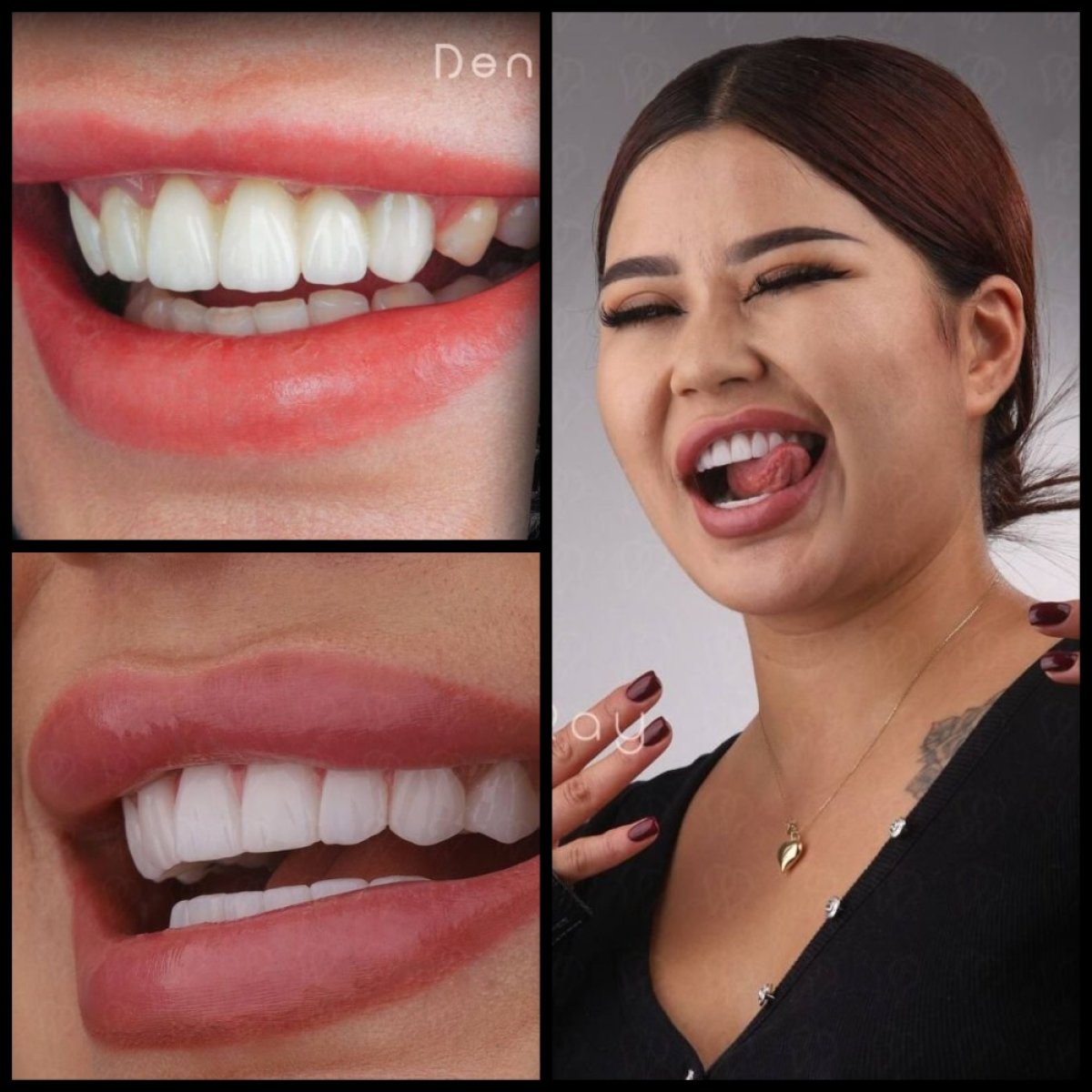 Resultados de Hollywood Smile antes y después en Dentaray Clinic, carillas dentales
