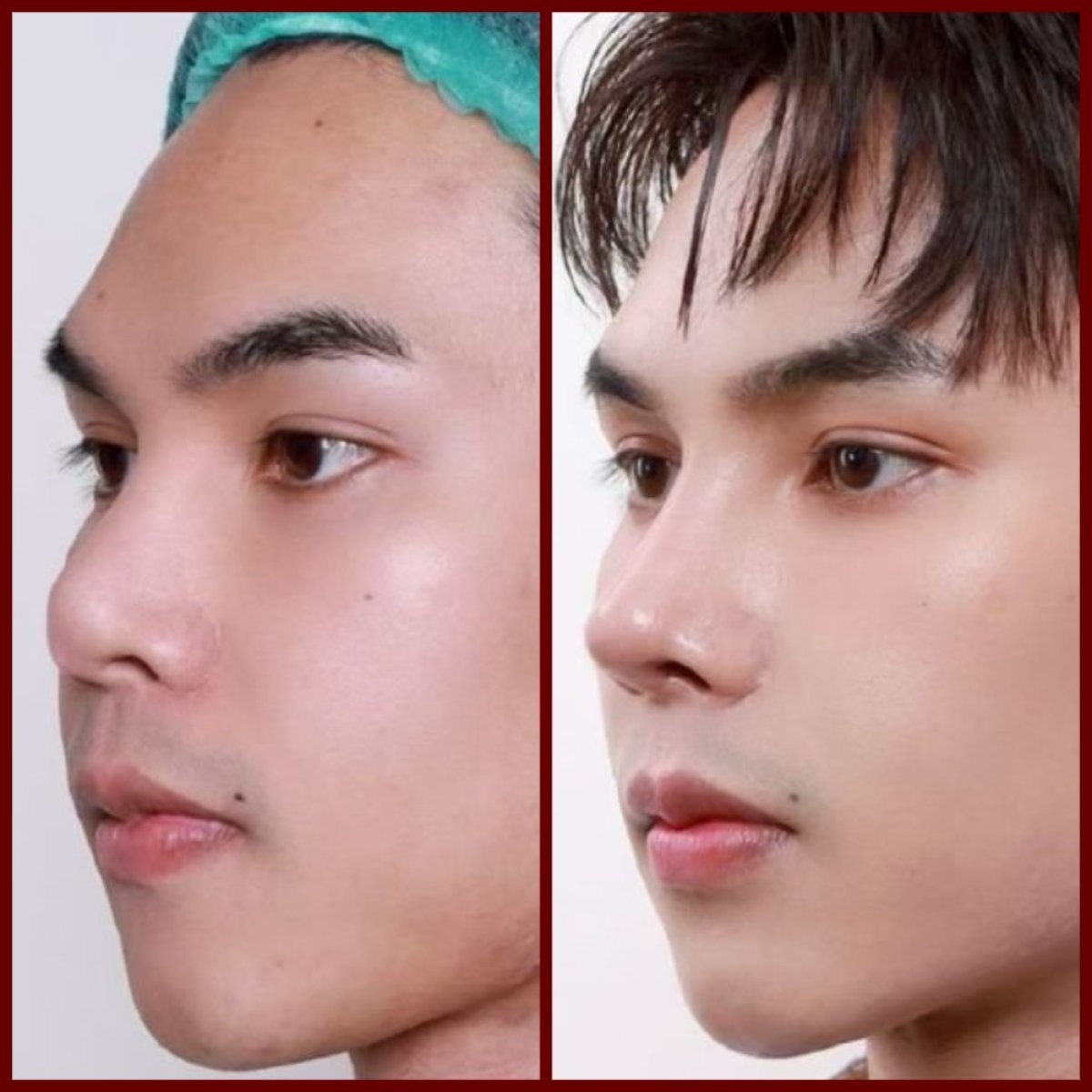 Before and after septoplasty results at DGB Clinic, improved nose shape and breathing