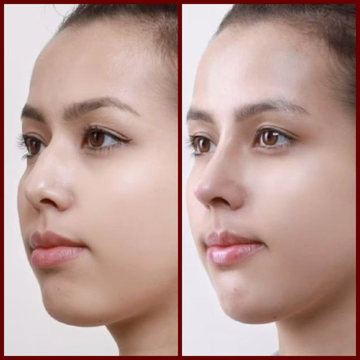 Before and after septoplasty at DGB Clinic – improved nose shape and breathing result