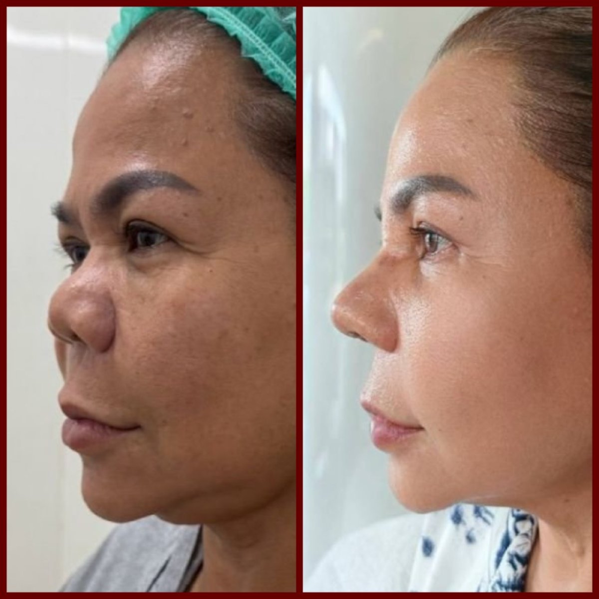 Before and after septoplasty results at DGB Clinic, improved nose shape after surgery