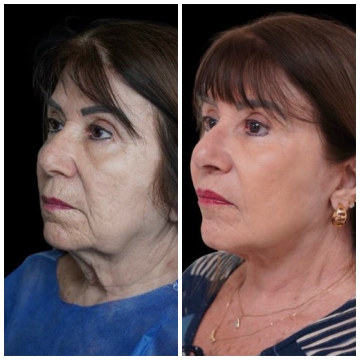 Before and after blepharoplasty results at Dr. Michel Salameh - Plastic And Aesthetic Surgery