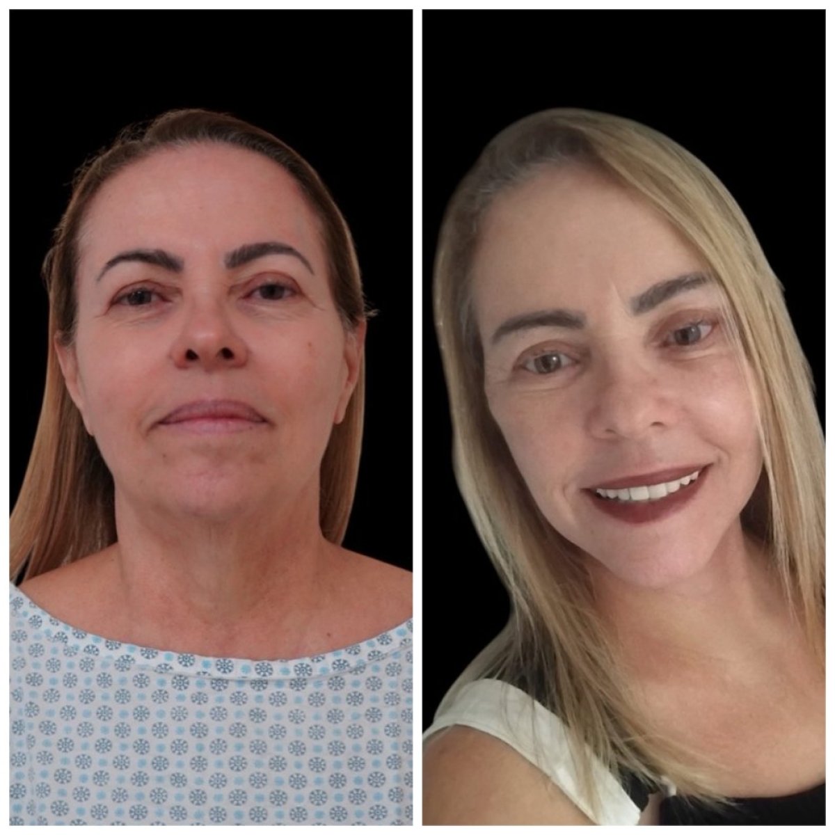 نتائج رأب الجفن قبل وبعد في عيادة Dr. Michel Salameh - Plastic And Aesthetic Surgery