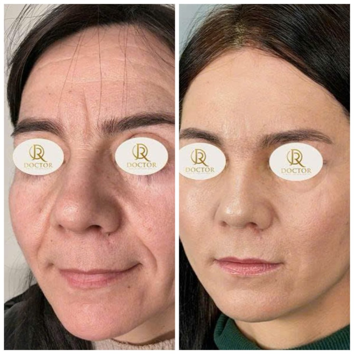 before and after photo