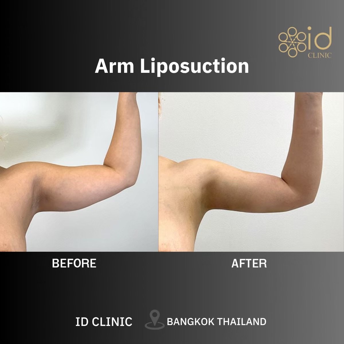 نتائج شفط دهون الذراع قبل وبعد في ID Clinic Bangkok، تحسين واضح لشكل الذراع
