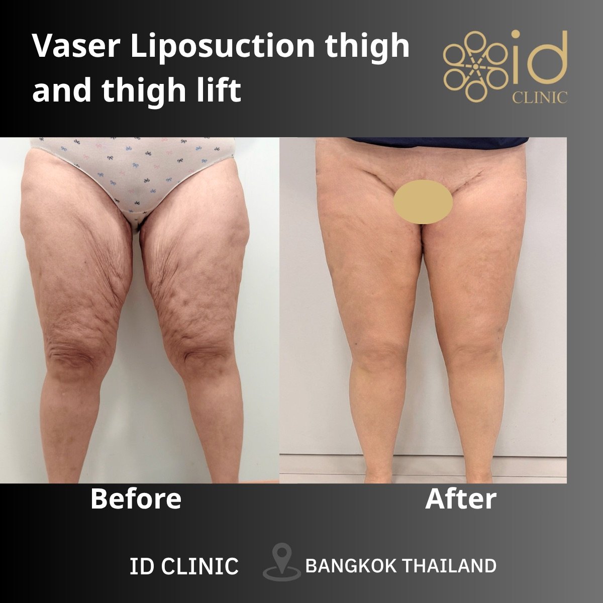 Результаты до и после Vaser липосакции и подтяжки бедер в ID Clinic Bangkok, стройные бедра