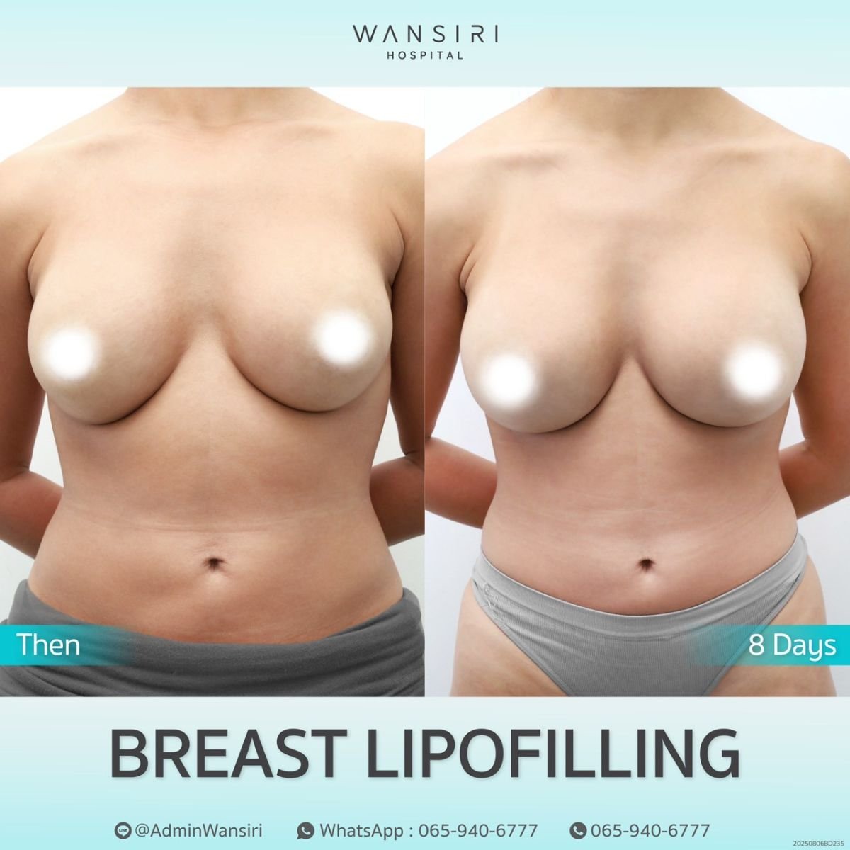 Resultados de lipofilling de senos antes y después en Wansiri Hospital, mejora en 8 días