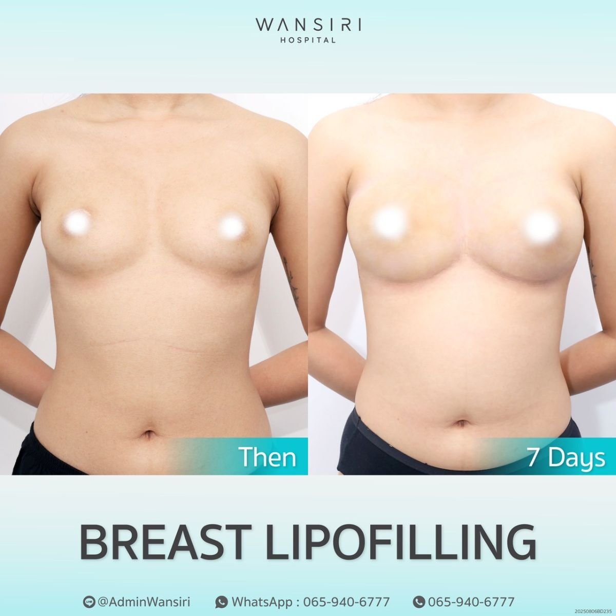 Résultats avant/après lipofilling mammaire à Wansiri Hospital, augmentation visible du volume