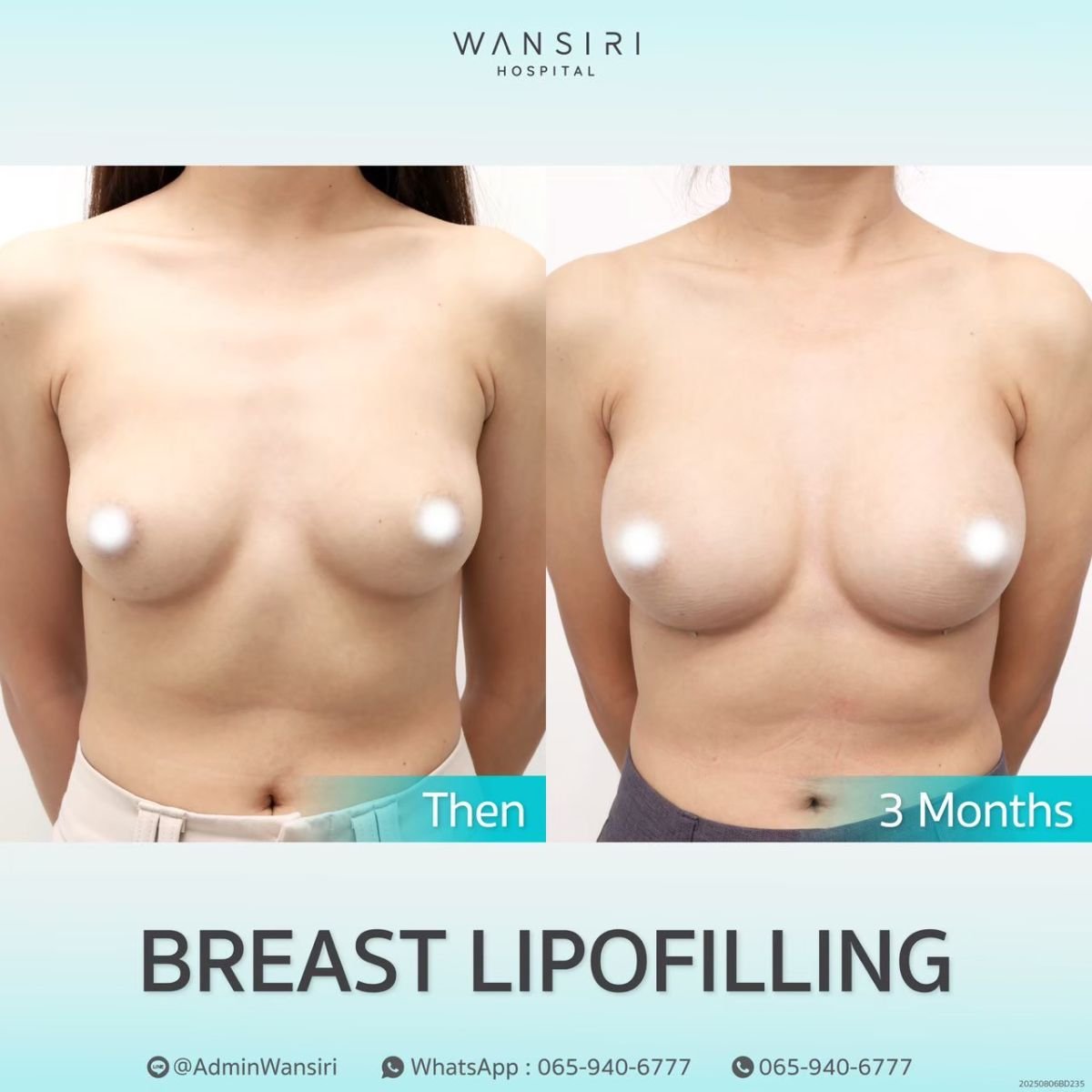 Resultados de lipofilling mamario antes y después en Wansiri Hospital, aumento visible de volumen