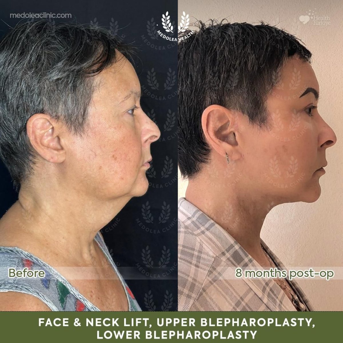 Resultados antes y después de lifting facial y de cuello, blefaroplastia en Medolea Clinic
