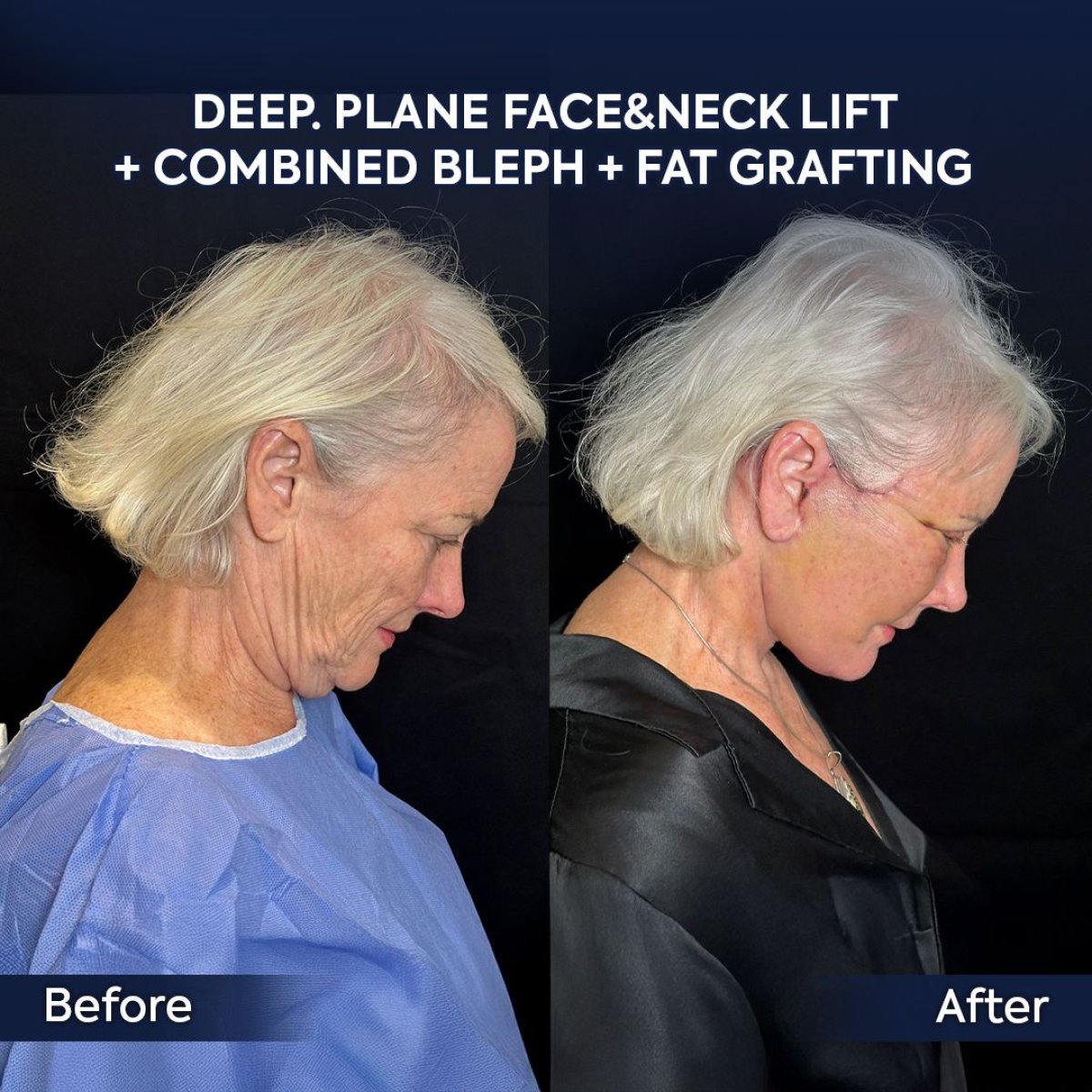 Resultados antes y después de lifting facial, cuello y blefaroplastia en Dr. Safa Manav Clinic