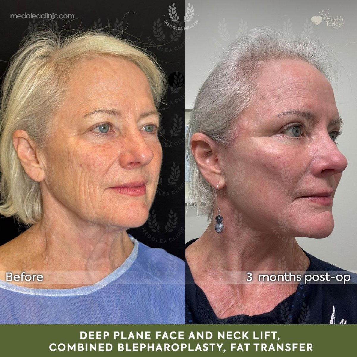 Before and after deep plane facelift and neck lift results at Dr. Safa Manav Clinic