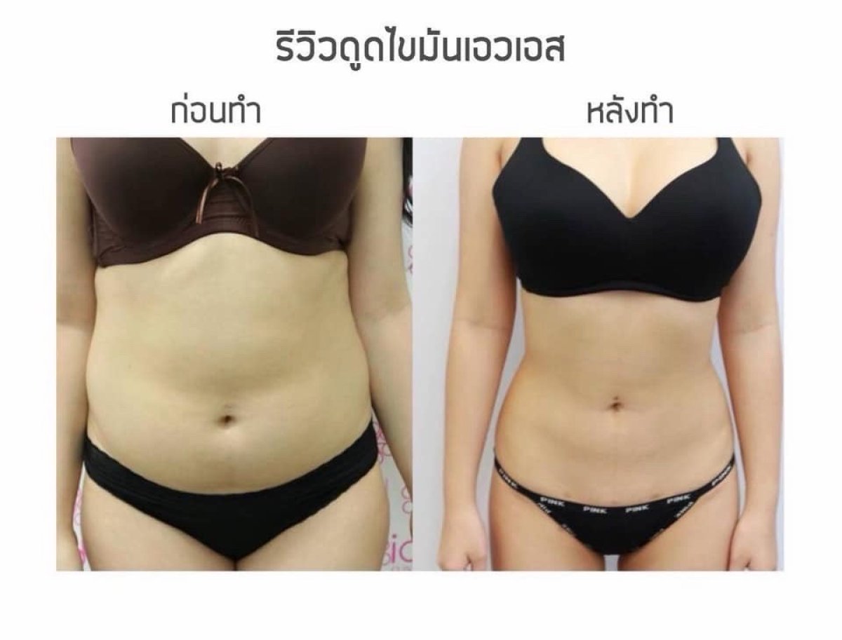 Resultados de liposucción antes y después en Somchai Clinic – cintura y abdomen más delgados