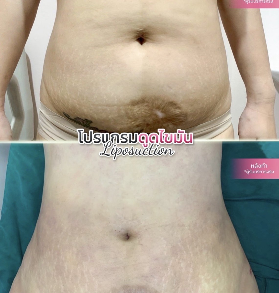 Resultados de liposucción abdominal antes y después en Somchai Clinic – reducción visible de grasa