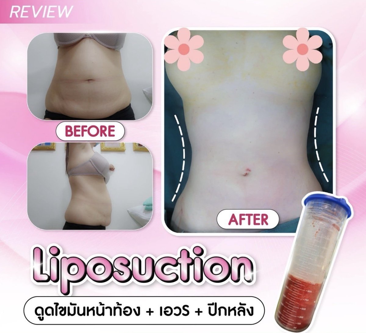 Resultados de liposucción antes y después en Somchai Clinic, contorno visible de cintura y abdomen