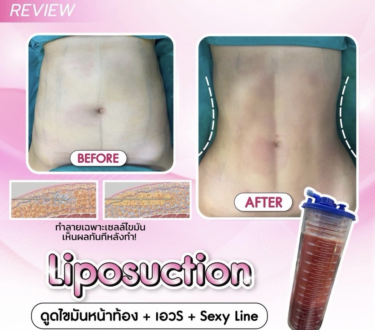 Resultados de liposucción antes y después en Somchai Clinic: mejora visible del abdomen