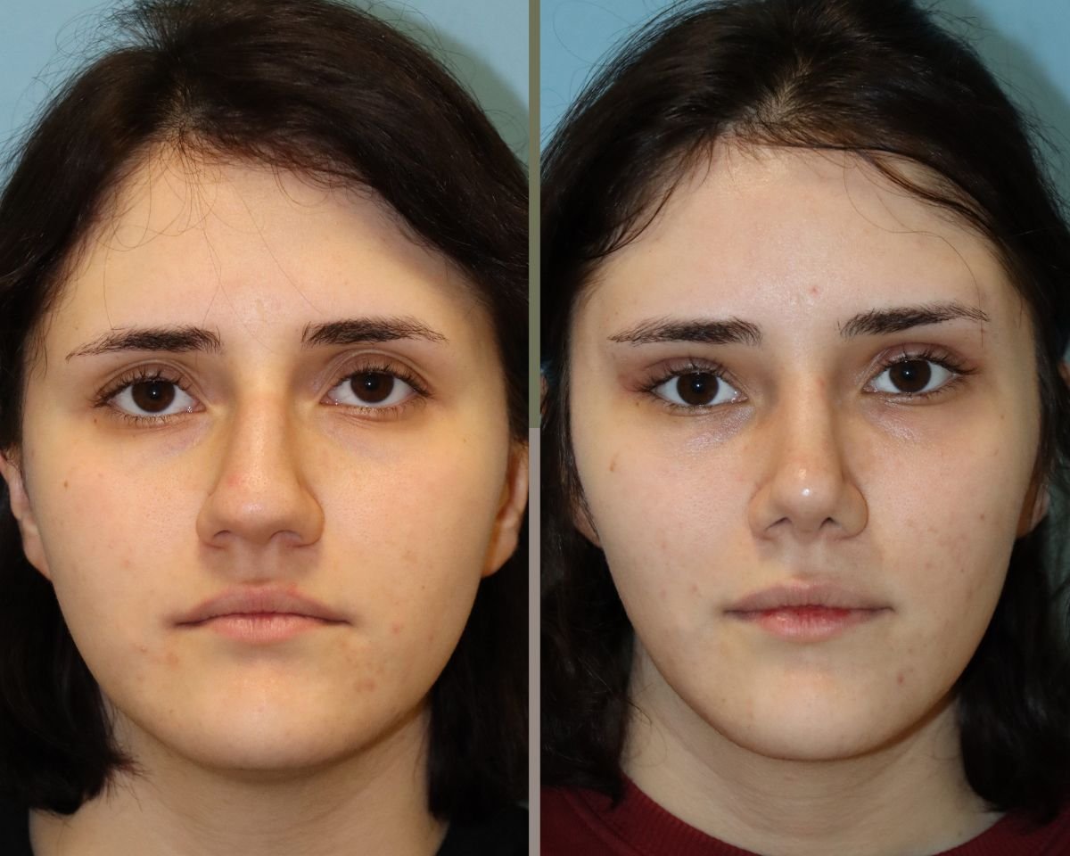 Resultados de blefaroplastia superior antes y después en Memorial Şişli Hospital, rejuvenecimiento ocular