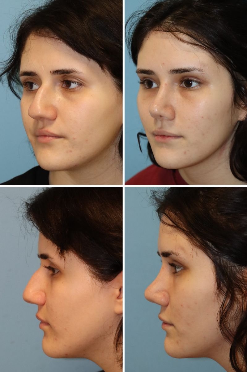 Resultados de rinoplastia antes y después en Memorial Şişli Hospital, mejora de la nariz