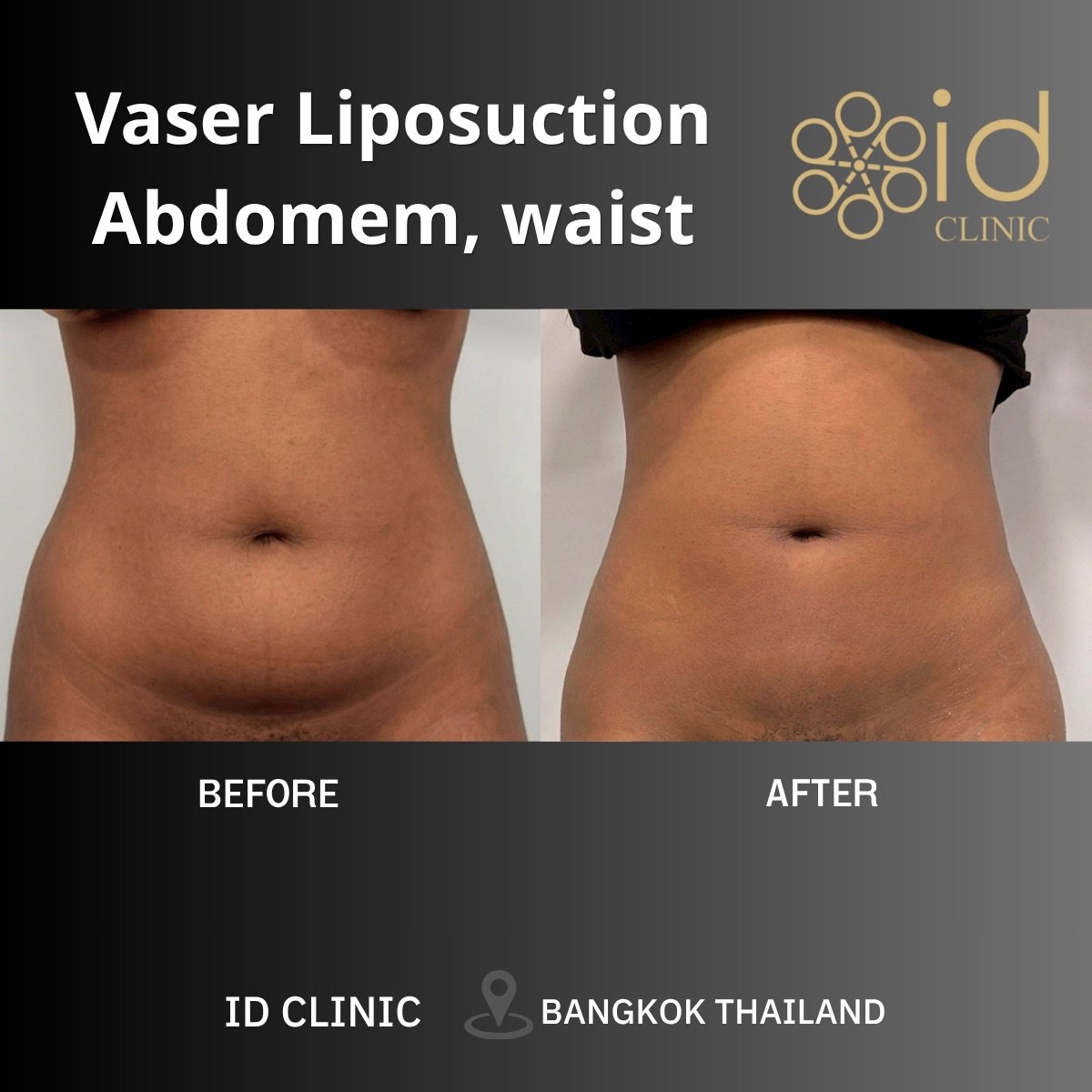 Resultados antes y después de liposucción Vaser abdomen y cintura en ID Clinic Bangkok