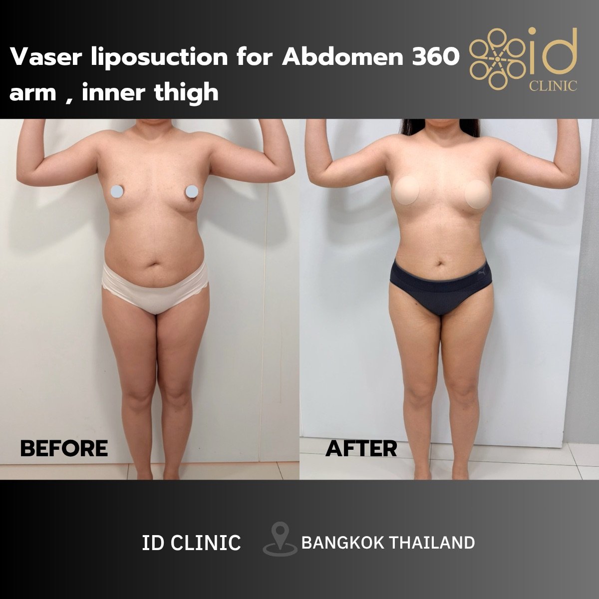 Resultados de liposucción Vaser en abdomen, brazos y muslos internos en ID Clinic Bangkok