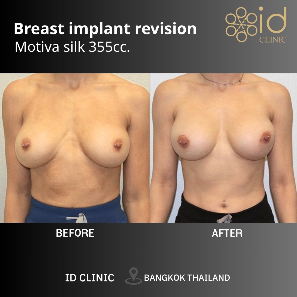 Resultados antes y después de revisión de implantes mamarios Motiva 355cc en ID Clinic Bangkok