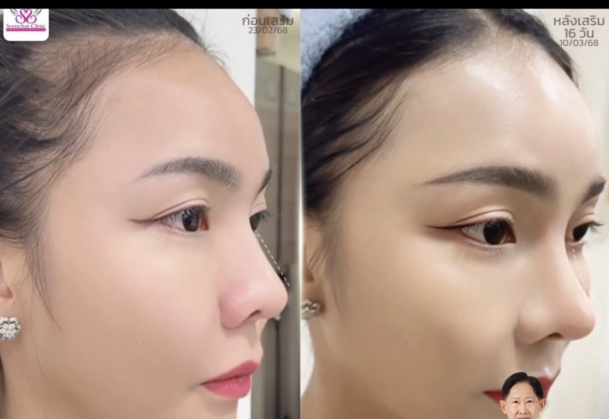 before and after photo