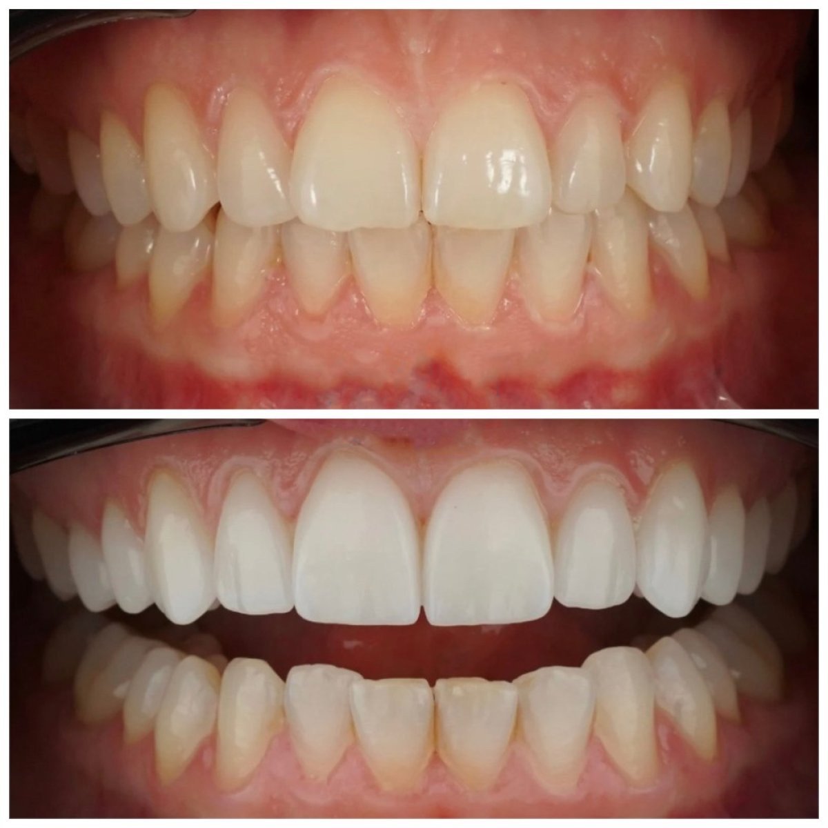 Resultados antes y después de bonding dental en Nifa Dent International – sonrisa mejorada
