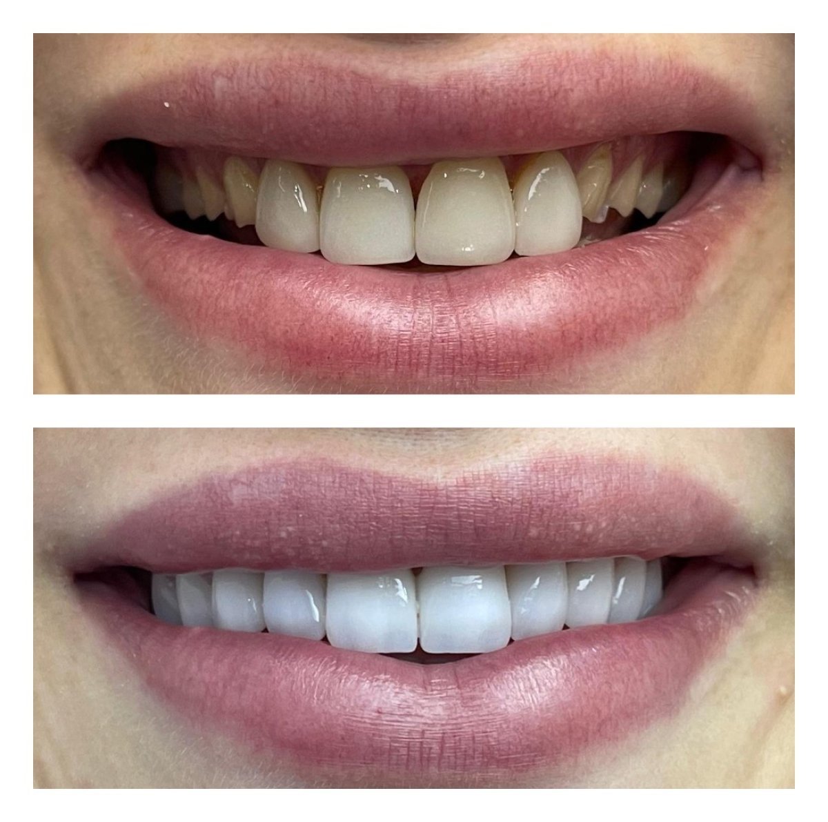 Resultados de antes y después de bonding dental en Nifa Dent International – sonrisa mejorada