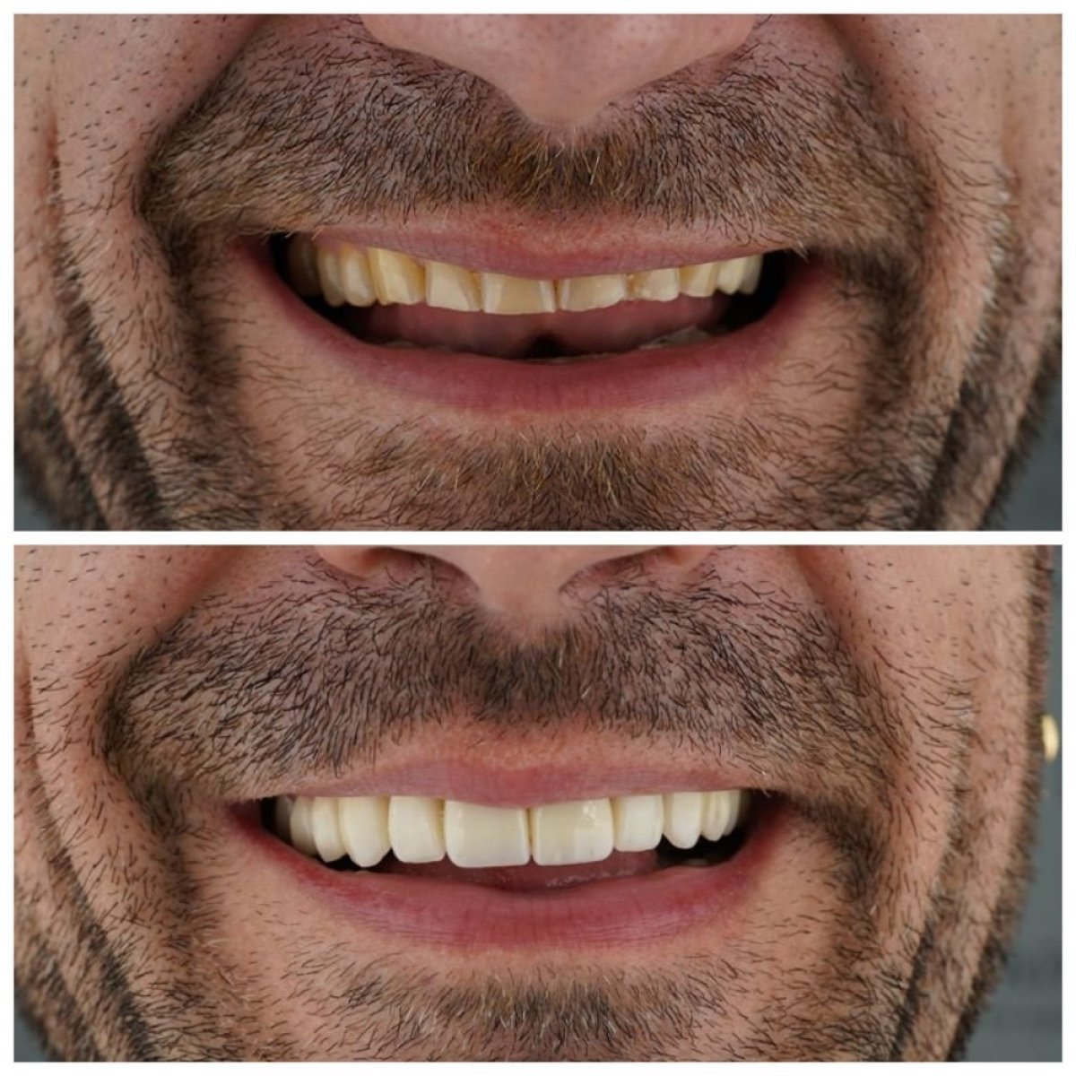 Resultados de antes y después de bonding dental en Nifa Dent International, sonrisa mejorada
