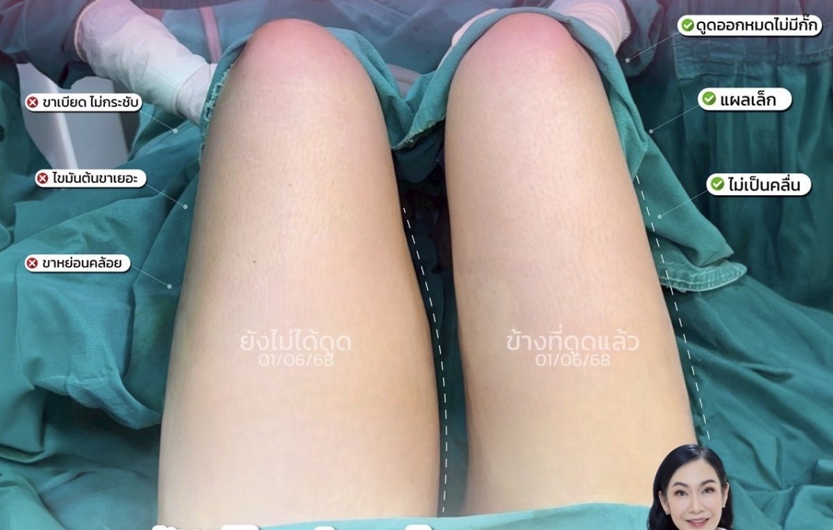 نتيجة شفط الدهون للفخذين قبل وبعد في عيادة Somchai، تحسين واضح لشكل الساقين