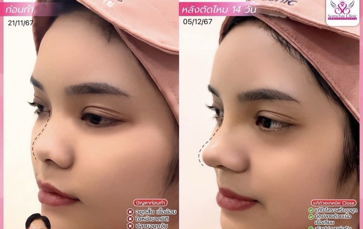 نتائج تجميل الأنف قبل وبعد في عيادة سومشاي، إعادة تشكيل الأنف بمظهر طبيعي