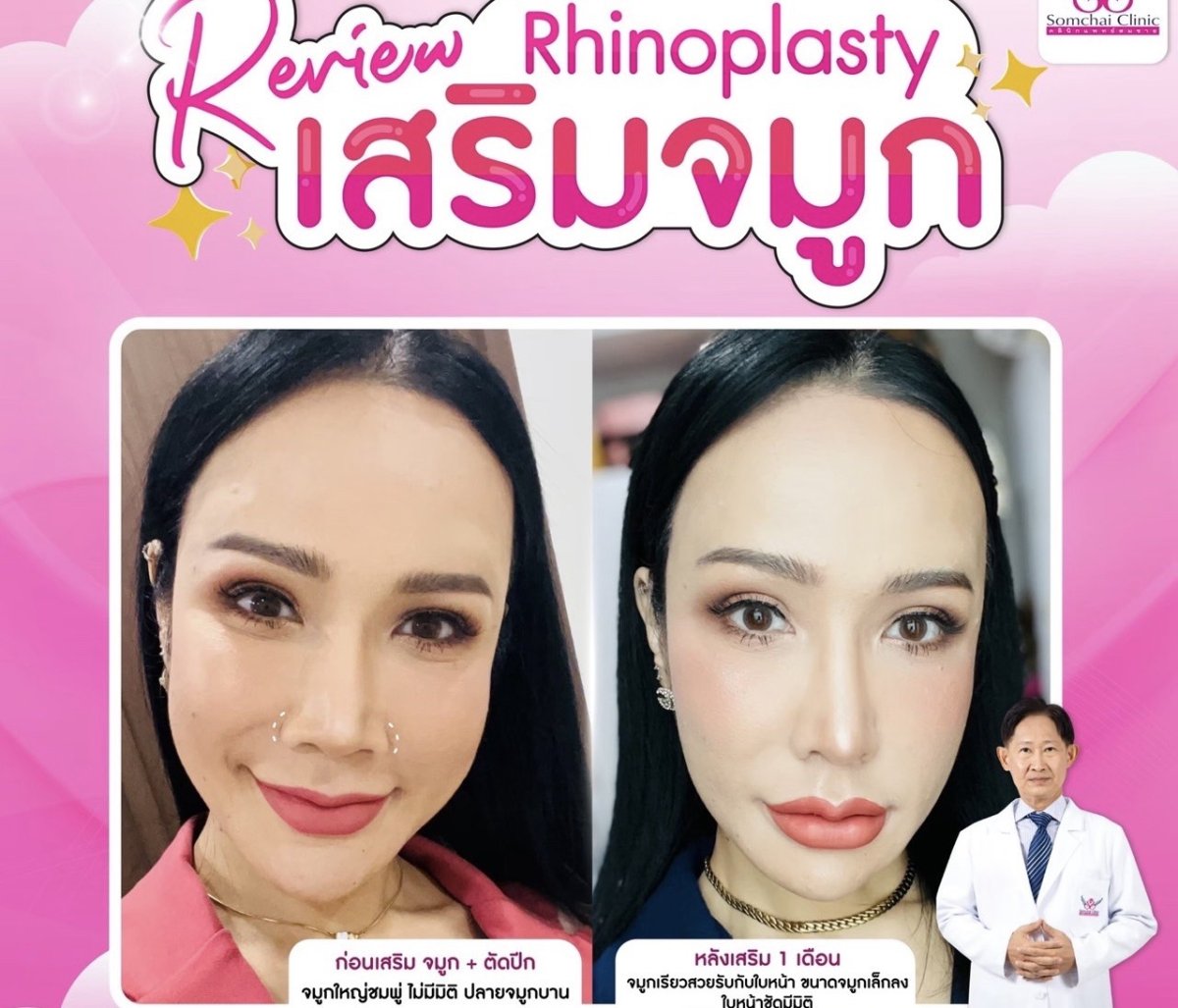 Résultats avant et après rhinoplastie à la clinique Somchai, affinement du nez