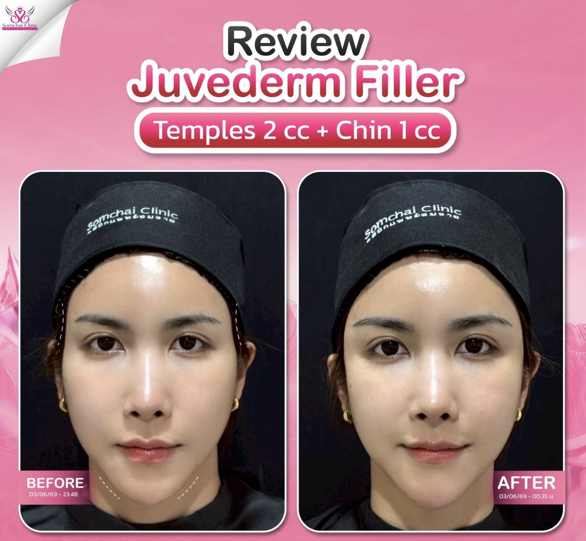Before and after Juvederm filler at Somchai Clinic, temples and chin enhancement results