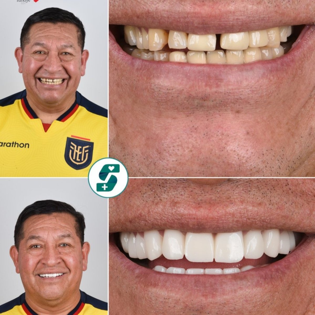 قبل وبعد تركيب تيجان الزركونيا في Soraca Med – نتائج تجميل الابتسامة