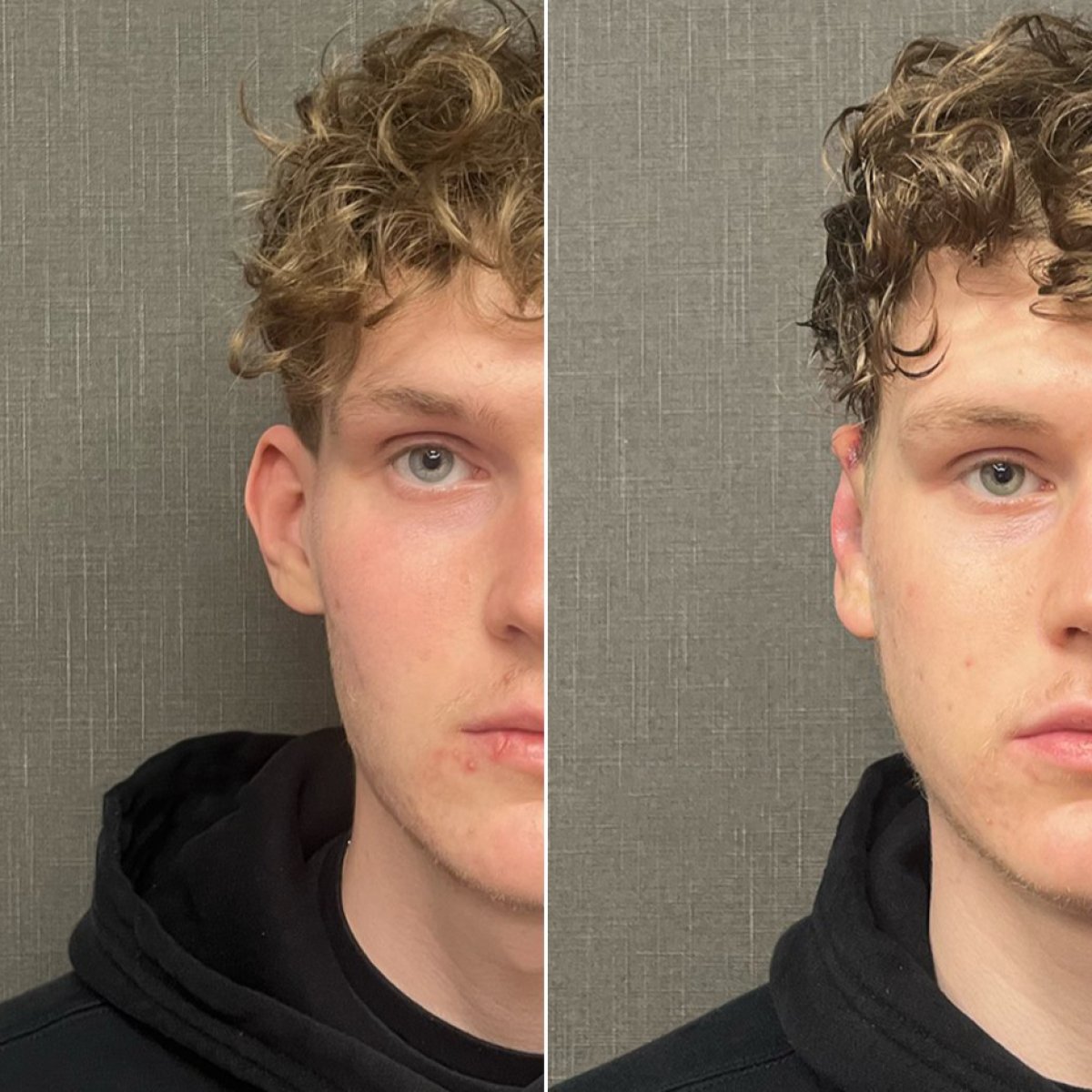 Before and after otoplasty results at Soraca Med, improved ear shape and symmetry