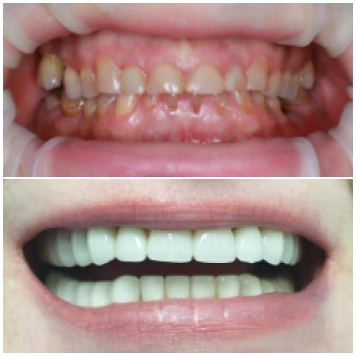 Before and after veneers result at Factor Smile Dental Clinic, smile transformation visible