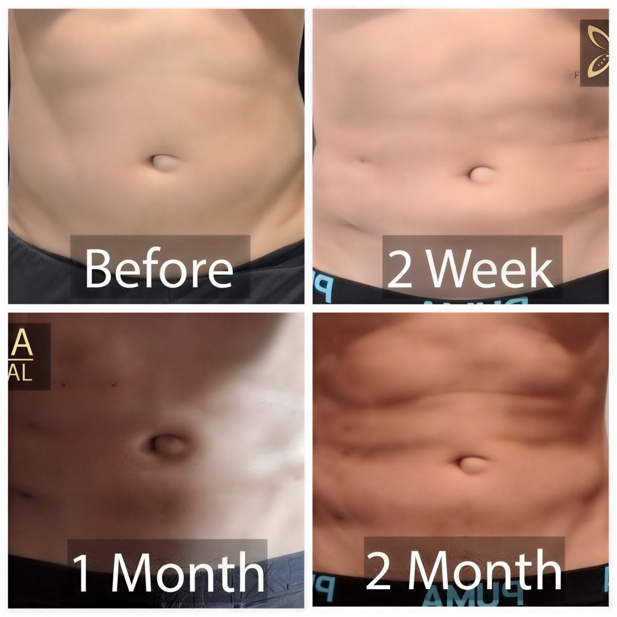 Abdominal etching before and after results at Asia Cosmetic Hospital, visible six pack abs
