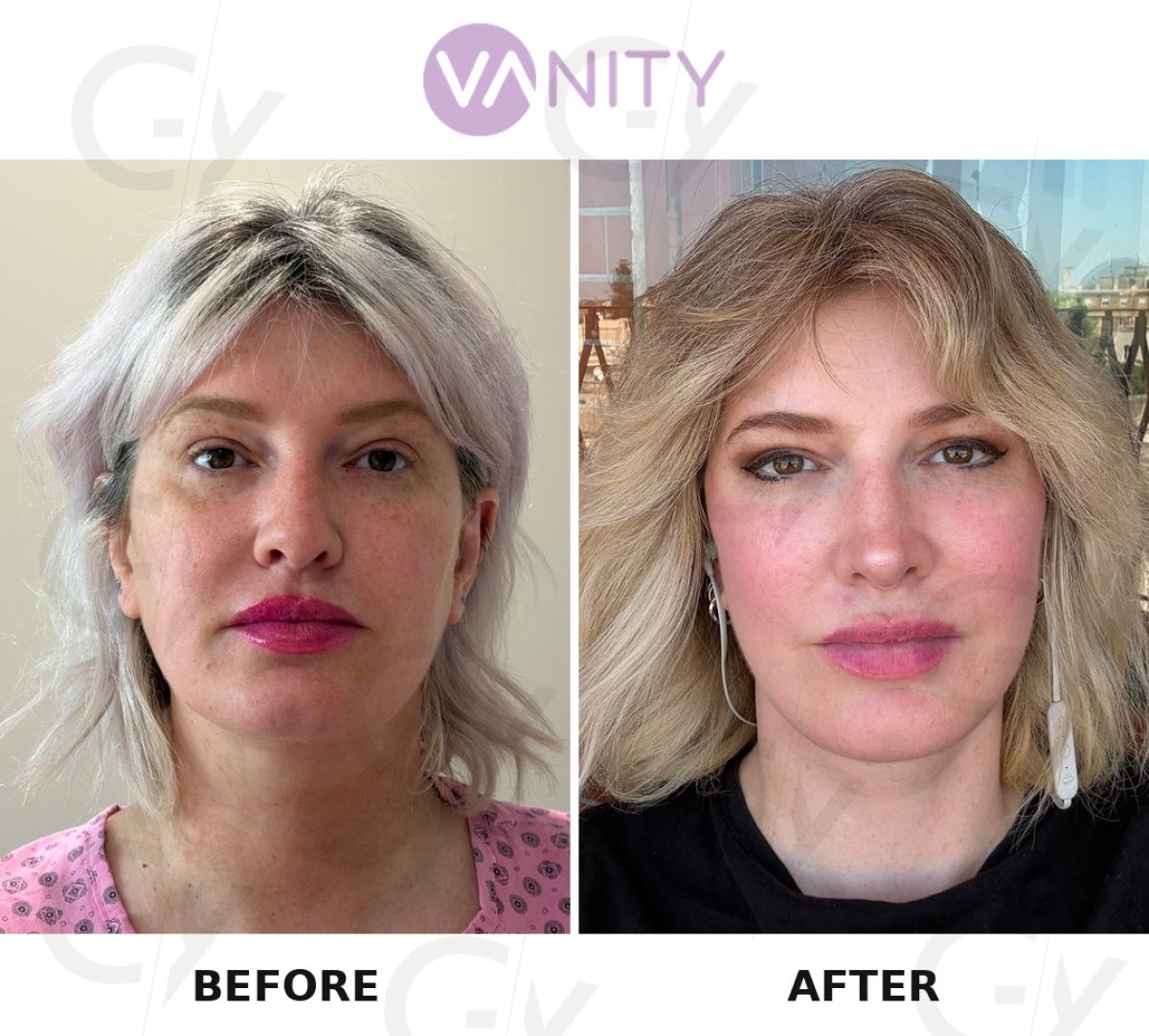 Resultados de lifting facial antes y después en Vanity Cosmetic Surgery Center, rejuvenecimiento