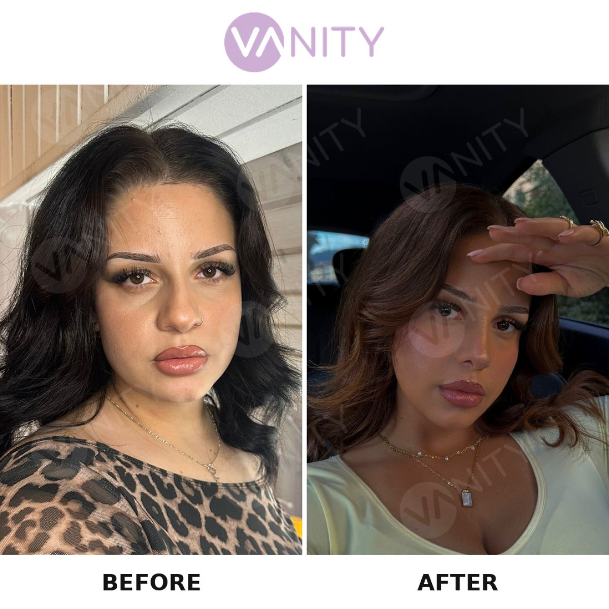 نتائج عملية تجميل الأنف قبل وبعد في Vanity Cosmetic Surgery Center، شكل أنف مصقول