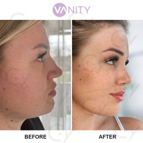 Standard Rhinoplasty (nose job) - photo 4