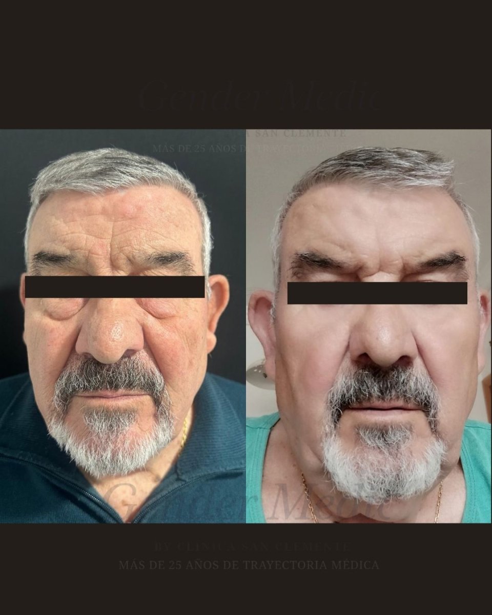 Resultados de blefaroplastia antes y después en Gender Medic Unit, mejora visible de párpados