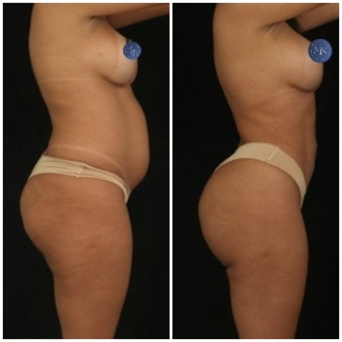 Vorher-nachher-Ergebnisse 360°-Liposuktion bei Dr. Michel Salameh - Plastic And Aesthetic Surgery