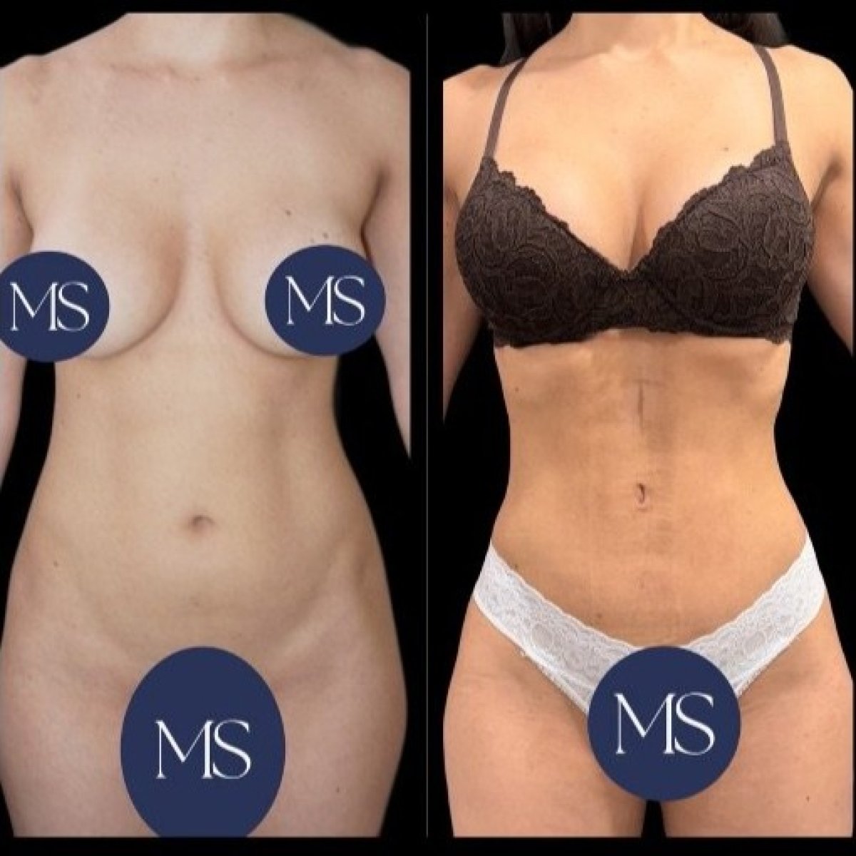 Resultados de lipoescultura 360 antes y después en Dr. Michel Salameh - Plastic And Aesthetic Surgery