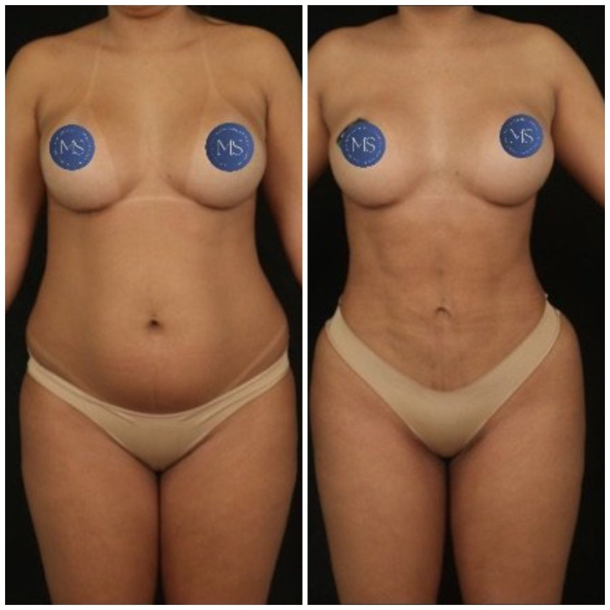 Resultados de liposucción 360 antes y después en Dr. Michel Salameh - Plastic And Aesthetic Surgery