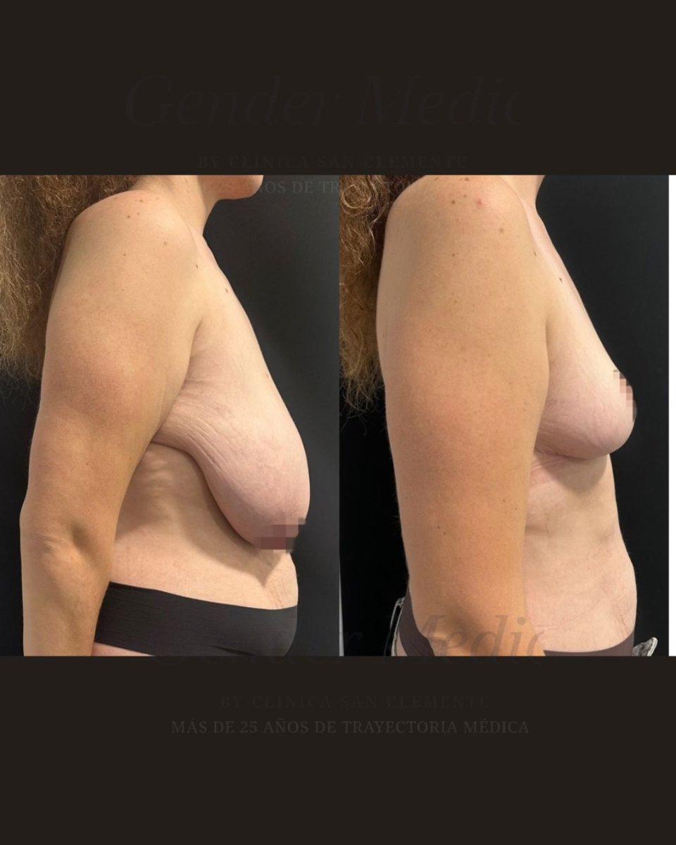 Resultados de mastopexia antes y después en Gender Medic Unit, mejor contorno y firmeza