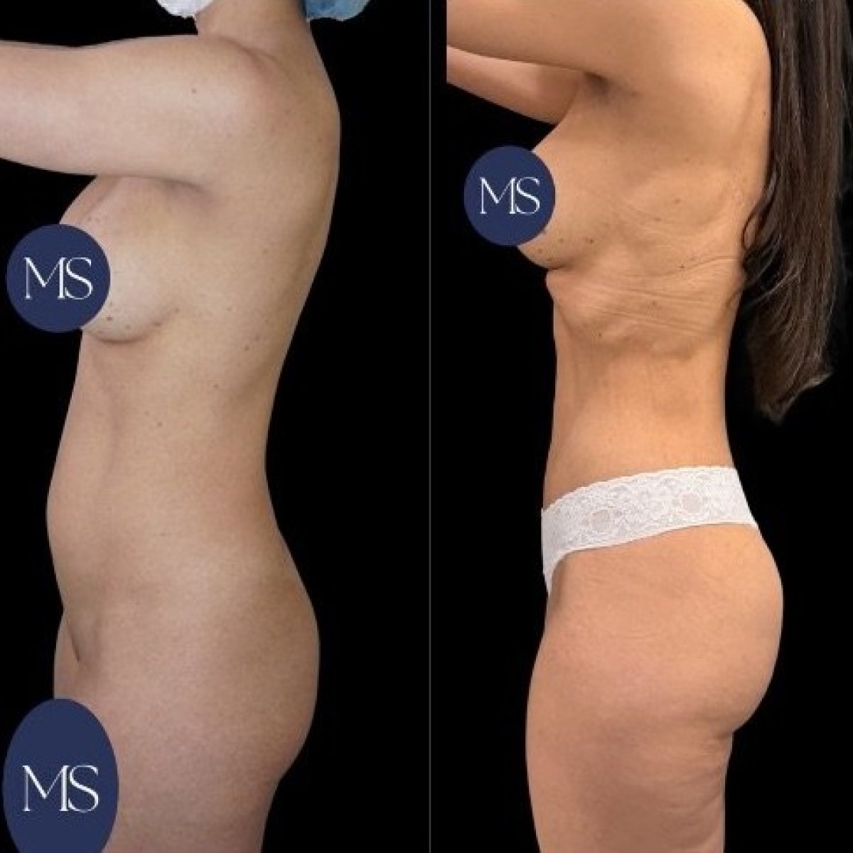 Resultados de liposucción 360 antes y después en Dr. Michel Salameh - Plastic And Aesthetic Surgery