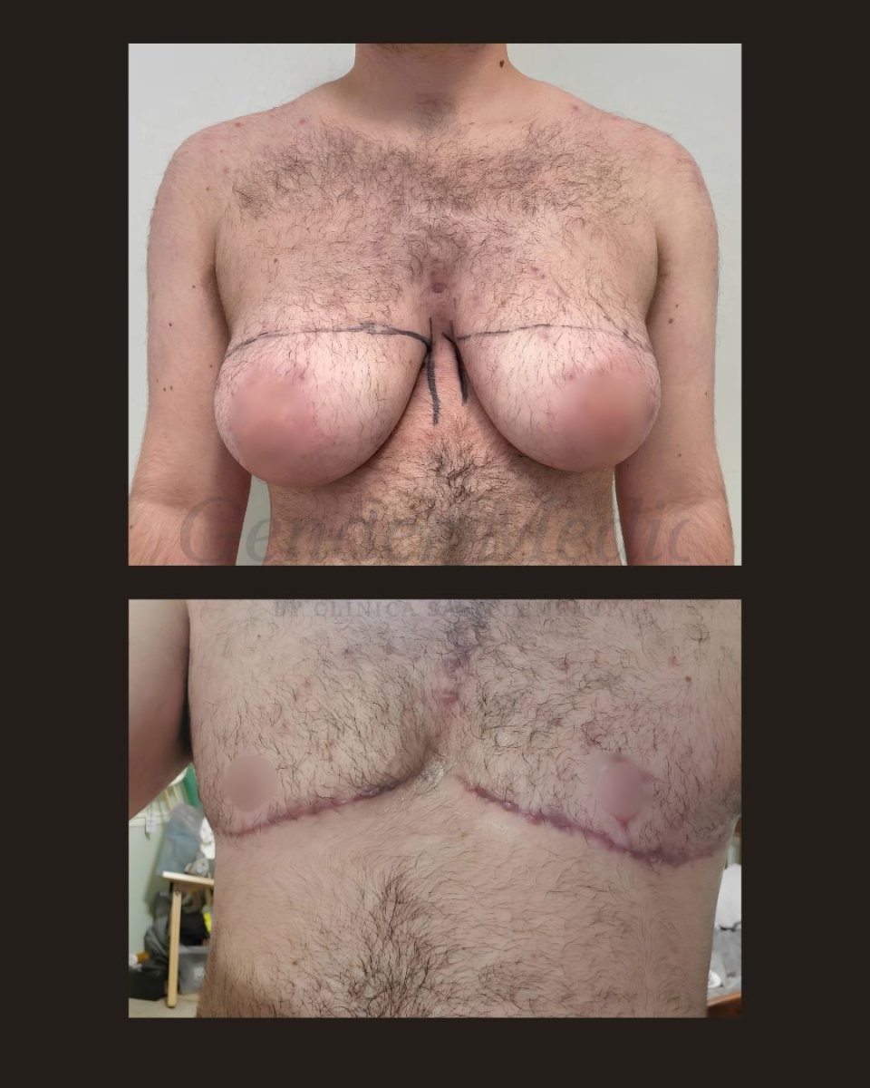 Resultados de masculinización corporal antes y después en Gender Medic Unit, contorno torácico