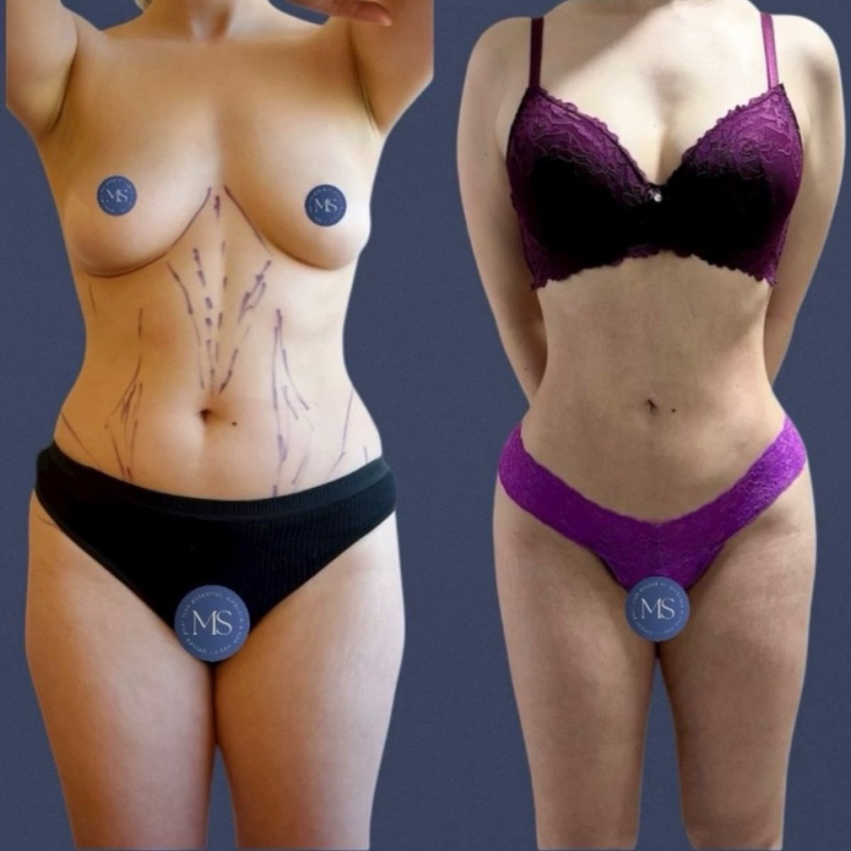 Resultados de liposucción 360 antes y después en Dr. Michel Salameh - Plastic And Aesthetic Surgery