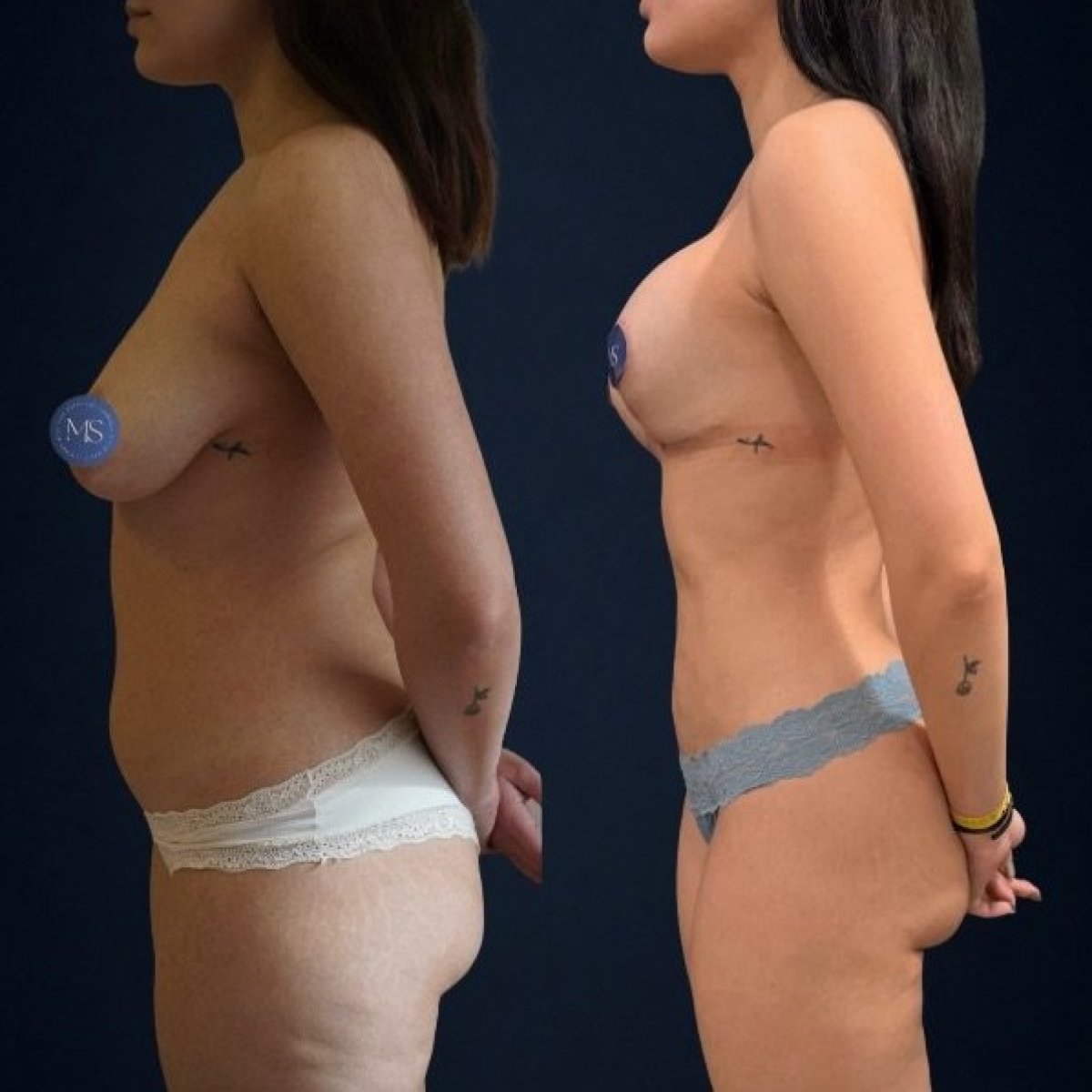 Before and after 360 liposuction results at Dr. Michel Salameh - Plastic And Aesthetic Surgery