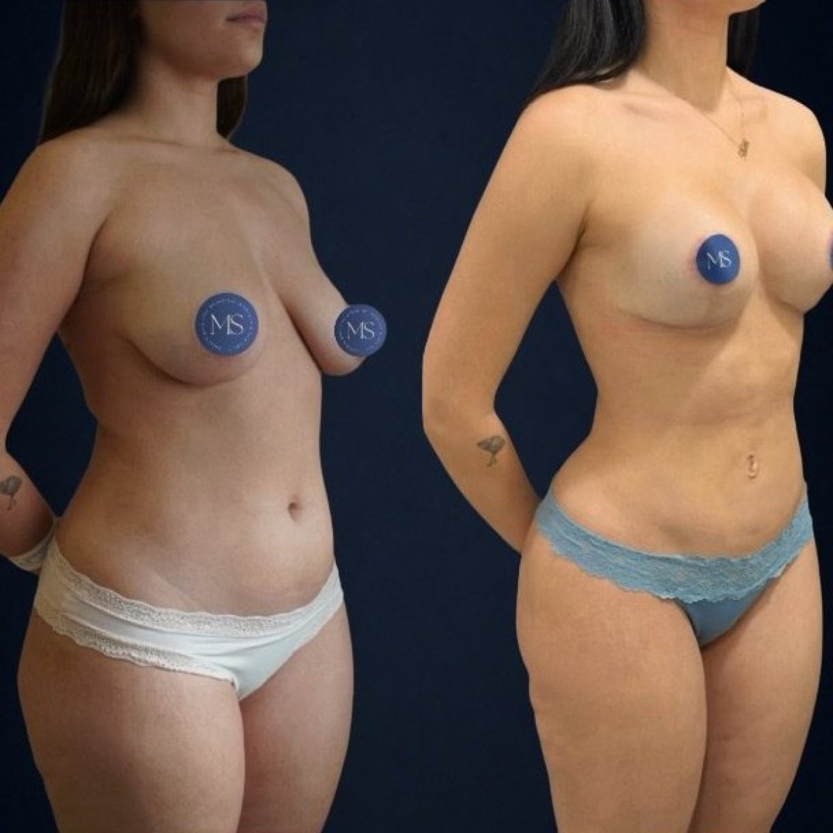 Efekty 360 liposukcji przed i po w Dr. Michel Salameh - Plastic And Aesthetic Surgery
