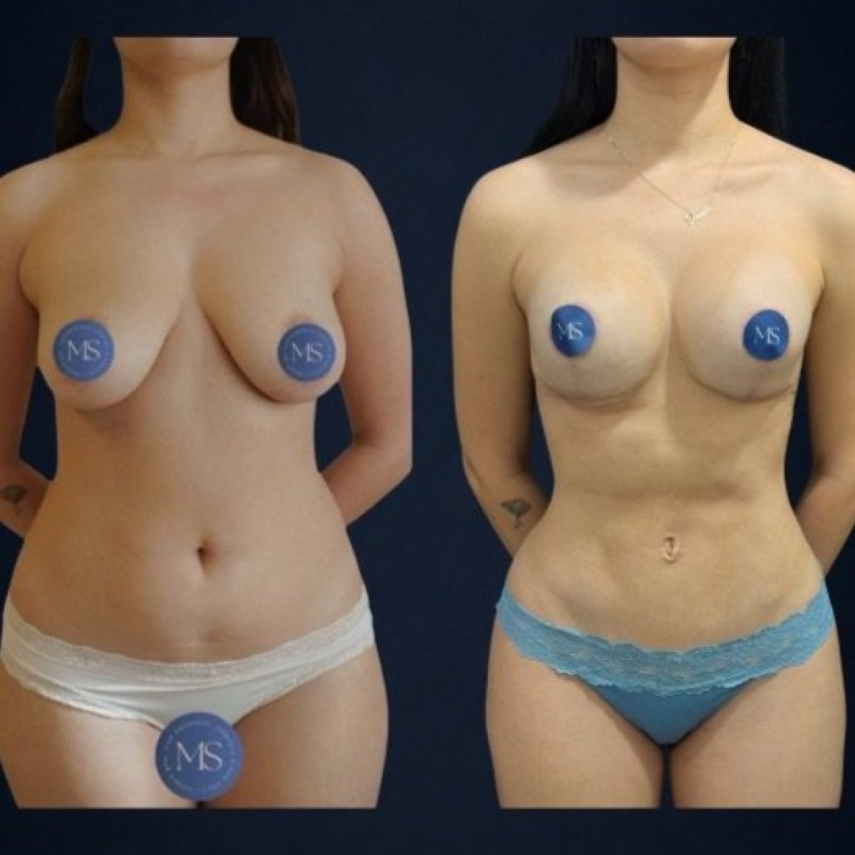 Efekty 360 liposukcji przed i po w Dr. Michel Salameh - Plastic And Aesthetic Surgery